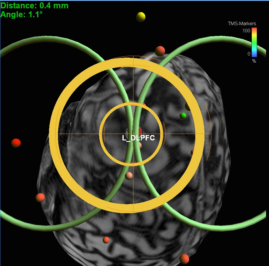 TMS_Treatment